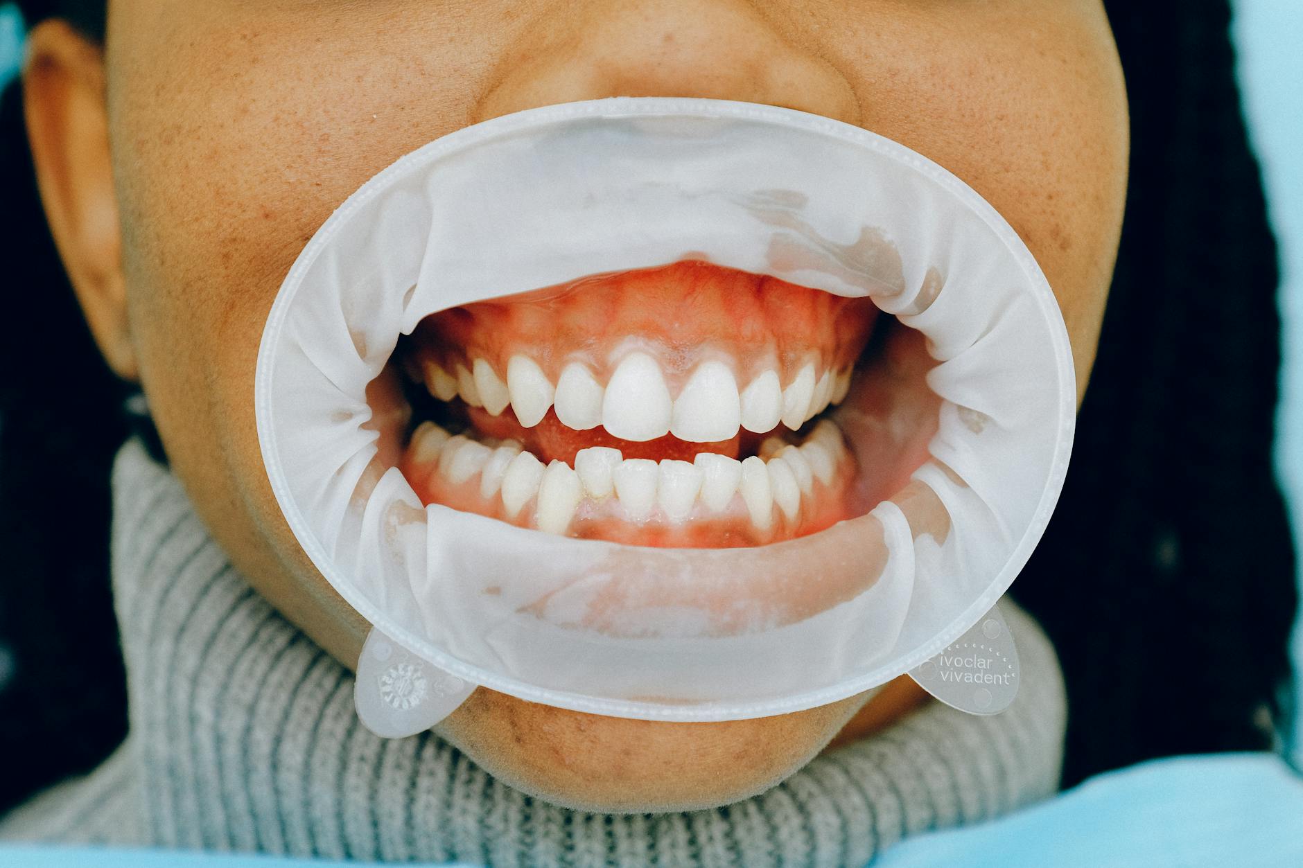 Gejala Umum Periodontitis yang Harus Diwaspadai