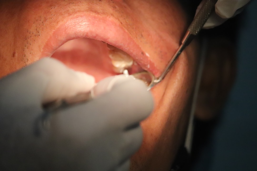 5 Penyebab Utama Tonsil Stones