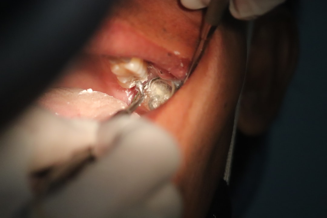 5 Penyebab Utama Tonsil Stones