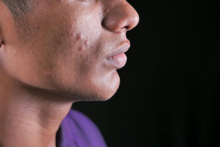 Mengenali Penyebab Acne Vulgaris dan Cara Efektif Mengatasinya